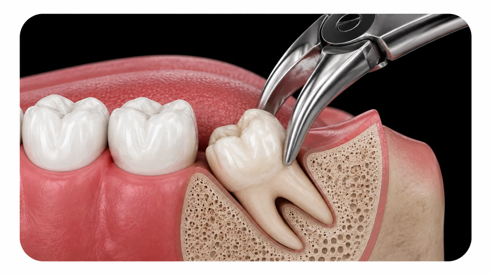 Wisdom Teeth Extraction Surgery