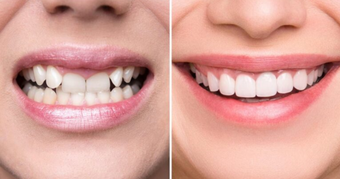 Smile Designing & Teeth Whitening